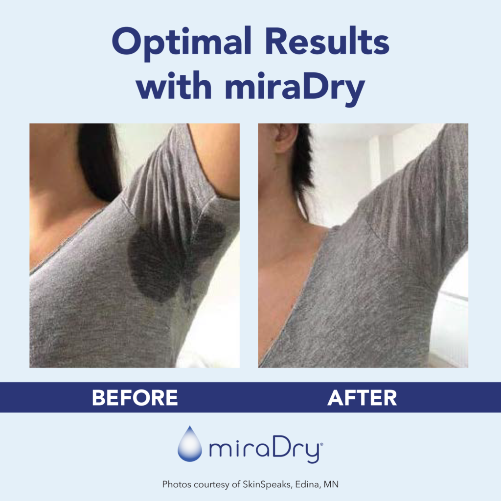 230518 mD Before After IG v2-01